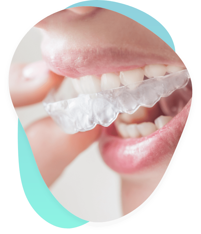 Invisalign Schiene